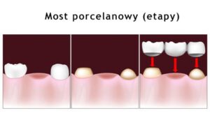 most-porcelanowy