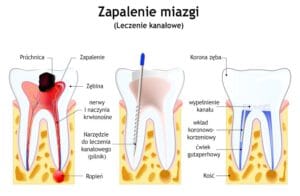 leczenie kanałowe zębów zapalenie