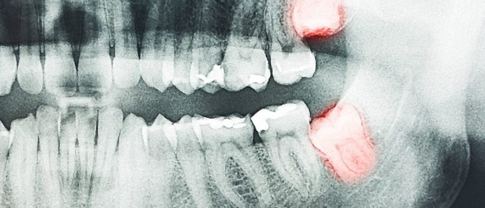 dentysta radzi – zęby mądrości