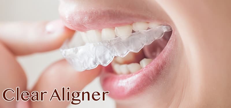Aparat ortodontyczny Clear Aligner